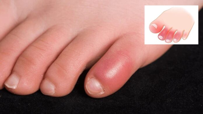 chilblain swollen feet image